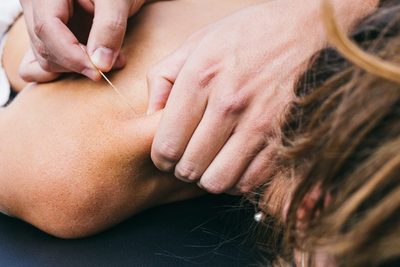 Person laying on a massage table face down receiving acupuncture on their neck